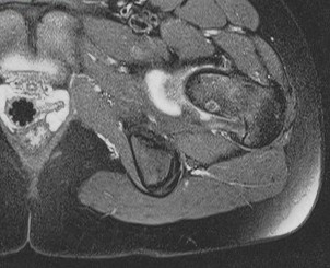 Figure 4 for case Osteoid osteoma ( RID4005 )